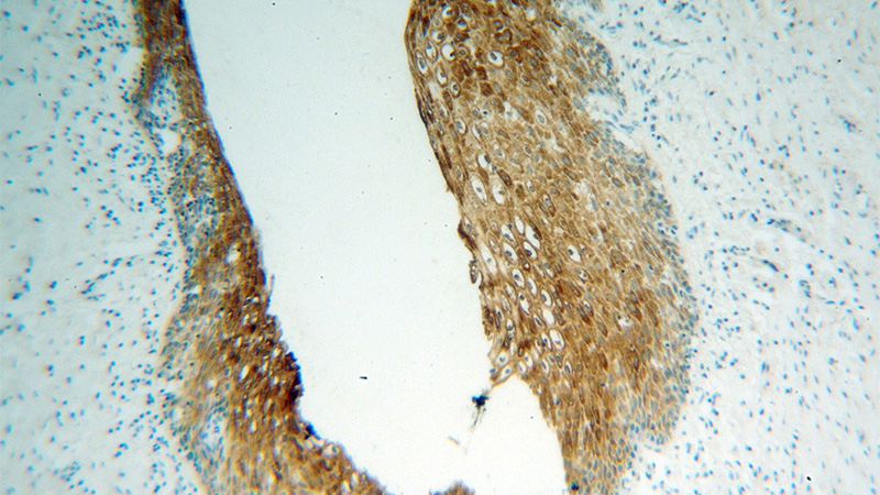 Immunohistochemical of paraffin-embedded human cervical cancer using Catalog No:112007(KIF22 antibody) at dilution of 1:100 (under 10x lens)