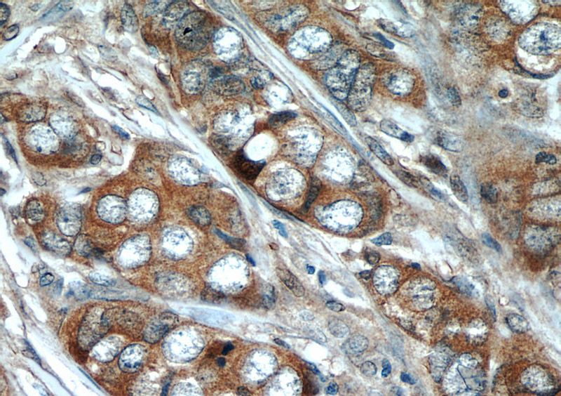 Immunohistochemical of paraffin-embedded human breast cancer using Catalog No:113023(NBR1 antibody) at dilution of 1:50 (under 40x lens)