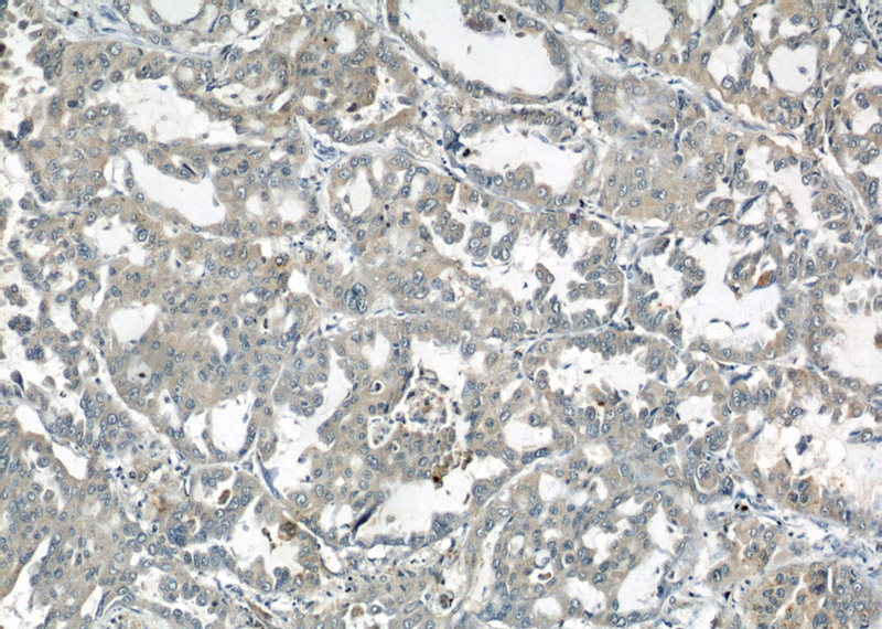 Immunohistochemical of paraffin-embedded human lung cancer using Catalog No:108167(ARPC4 antibody) at dilution of 1:50 (under 10x lens)