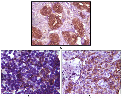 Immunohistochemical analysis of paraffin-embedded human breast tissue (A), lymph tissue (B) and skin carcinoma (C), showing membrane localization using BLK mouse mAb with DAB staining.