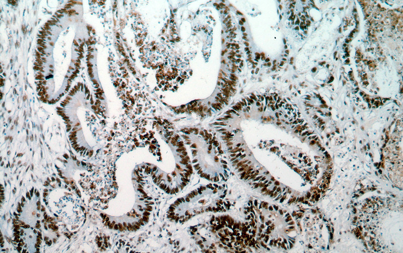 Immunohistochemical of paraffin-embedded human colon cancer using Catalog No:117084(NPM1 antibody) at dilution of 1:100 (under 10x lens)