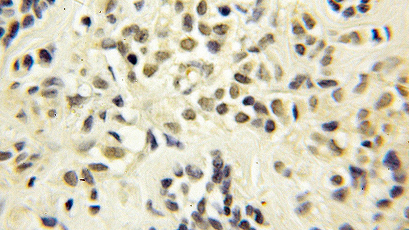 Immunohistochemical of paraffin-embedded human breast cancer using Catalog No:115900(TCEB1 antibody) at dilution of 1:50 (under 25x lens)
