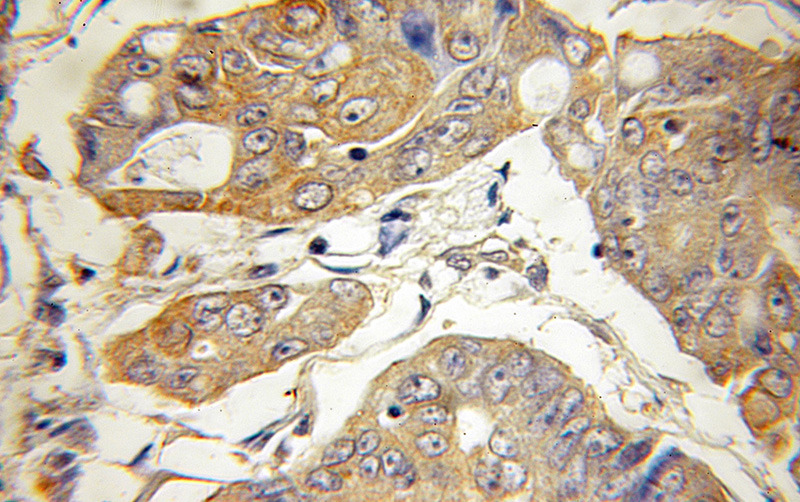 Immunohistochemical of paraffin-embedded human colon cancer using Catalog No:108299(ATG5 antibody) at dilution of 1:50 (under 10x lens)