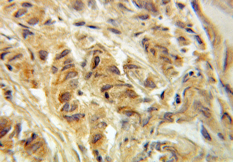 Immunohistochemical of paraffin-embedded human prostate cancer using Catalog No:107743(ACOT11 antibody) at dilution of 1:100 (under 10x lens)