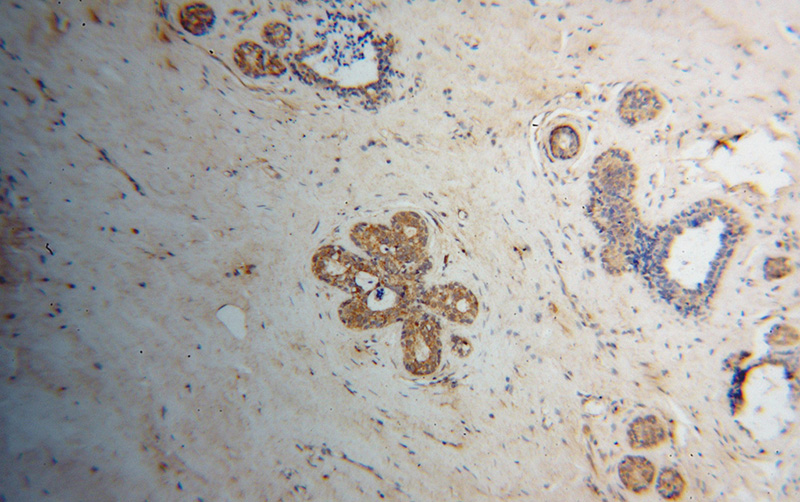 Immunohistochemical of paraffin-embedded human breast cancer using Catalog No:111278(HCCS antibody) at dilution of 1:100 (under 10x lens)