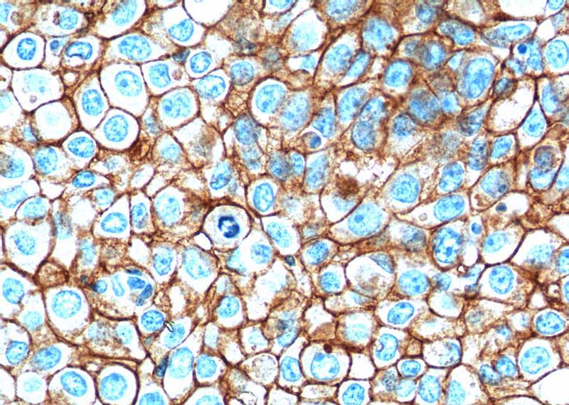 Immunohistochemistry of paraffin-embedded human breast cancer tissue slide using (EPCAM Antibody) at dilution of 1:500 (under 40x lens). Heat mediated antigen retrieved with Tris-EDTA buffer(pH9).