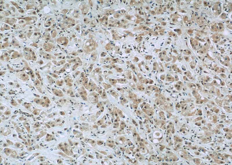 Immunohistochemistry of paraffin-embedded human breast cancer slide using Catalog No:110512(FAM98B Antibody) at dilution of 1:50