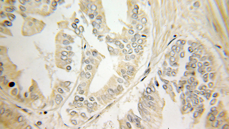 Immunohistochemical of paraffin-embedded human pancreas cancer using Catalog No:111553(HSD3B7 antibody) at dilution of 1:50 (under 10x lens)