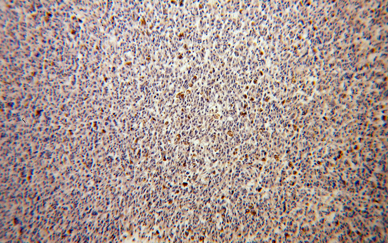 Immunohistochemical of paraffin-embedded human malignant melanoma using Catalog No:110835(GALE antibody) at dilution of 1:100 (under 10x lens)