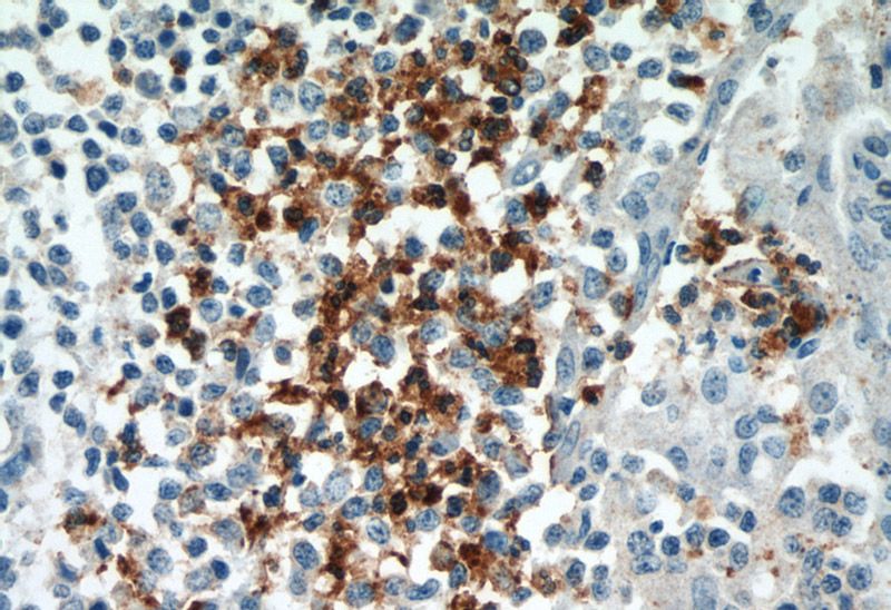 Immunohistochemical of paraffin-embedded human tonsillitis using Catalog No:109634(CX3CR1 antibody) at dilution of 1:50 (under 40x lens)
