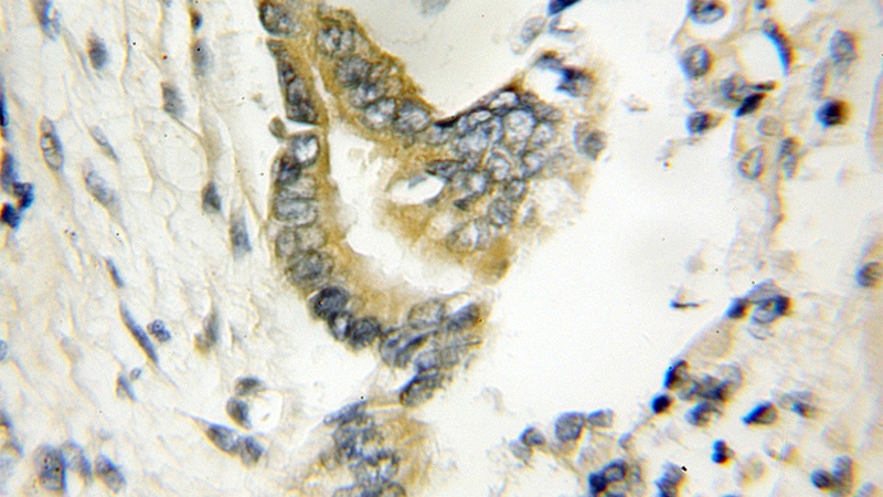 Immunohistochemical of paraffin-embedded human pancreas cancer using Catalog No:116498(TWF1 antibody) at dilution of 1:50 (under 10x lens)
