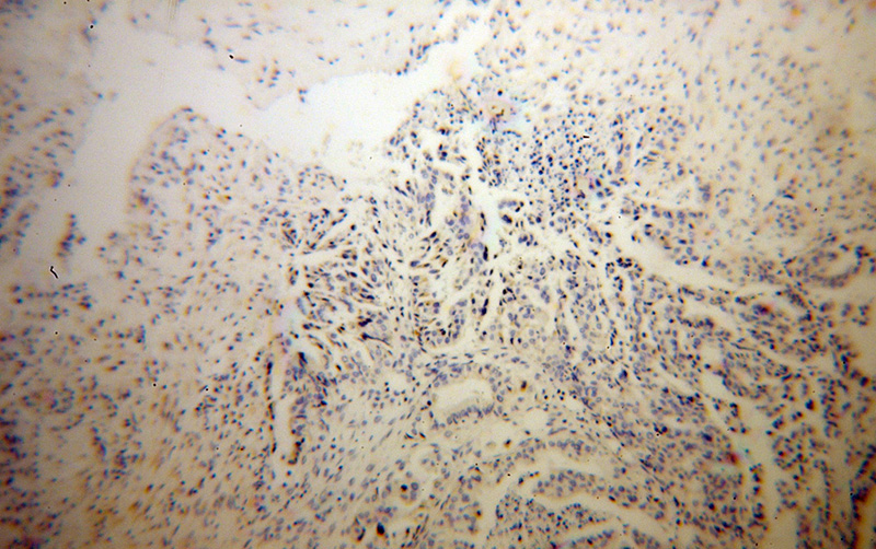 Immunohistochemical of paraffin-embedded human stomach cancer using Catalog No:112250(LMAN1 antibody) at dilution of 1:100 (under 10x lens)