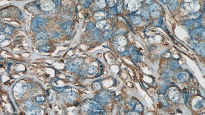 Immunohistochemical of paraffin-embedded human breast cancer using Catalog No:114663(ARHGDIA,aGDI antibody) at dilution of 1:50 (under 40x lens)