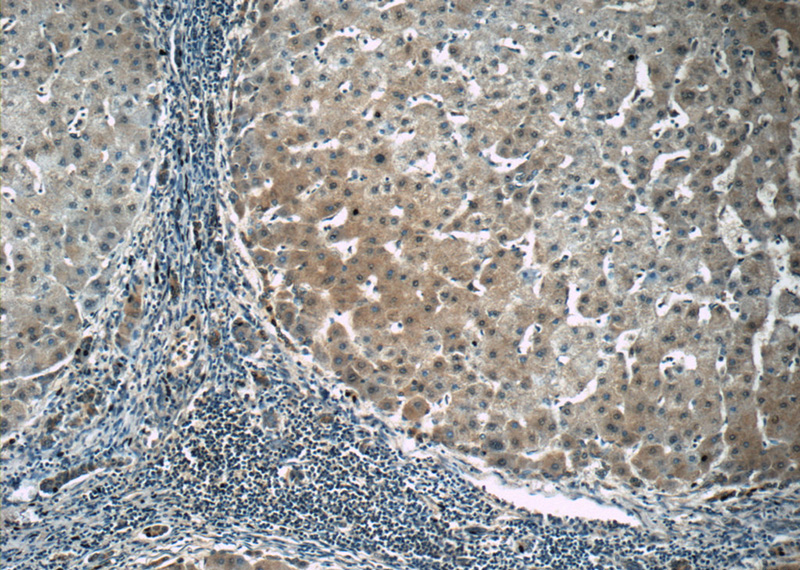 Immunohistochemistry of paraffin-embedded human hepatocirrhosis tissue slide using Catalog No:113784(PGK1 Antibody) at dilution of 1:50 (under 10x lens)