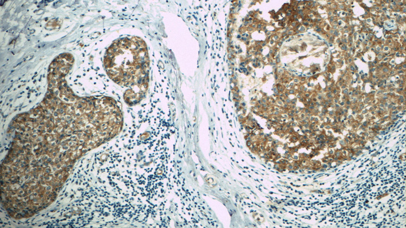 Immunohistochemistry of paraffin-embedded human breast cancer tissue slide using Catalog No:108131(APC Antibody) at dilution of 1:50. Heat mediated antigen retrieved with Citric acid buffer, pH6.0.