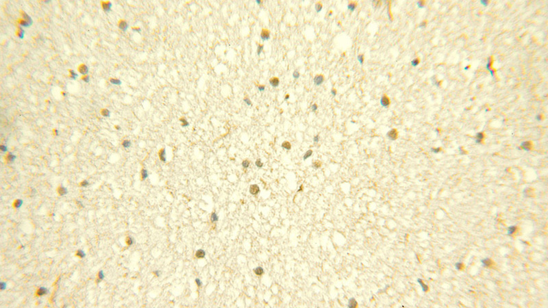 Immunohistochemical of paraffin-embedded human gliomas using Catalog No:113920(PKNOX1 antibody) at dilution of 1:100 (under 25x lens)