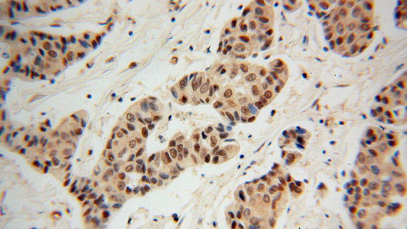 Immunohistochemical of paraffin-embedded human breast cancer using Catalog No:108938(EIF4E antibody) at dilution of 1:100 (under 40x lens)