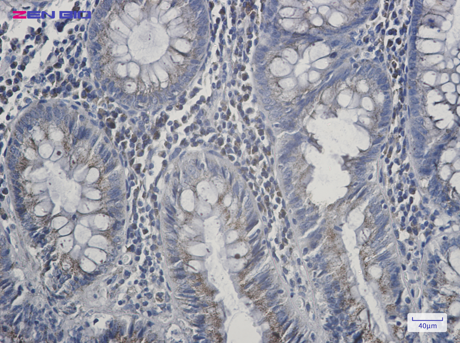 Immunohistochemistry of Alkyl-DHAP synthase in paraffin-embedded Human colon cancer tissue using Alkyl-DHAP synthase Rabbit pAb at dilution 1/20