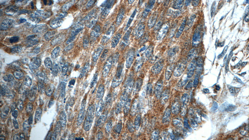 Immunohistochemistry of paraffin-embedded human skin cancer tissue slide using Catalog No:112853(MRPS26 Antibody) at dilution of 1:50 (under 40x lens)