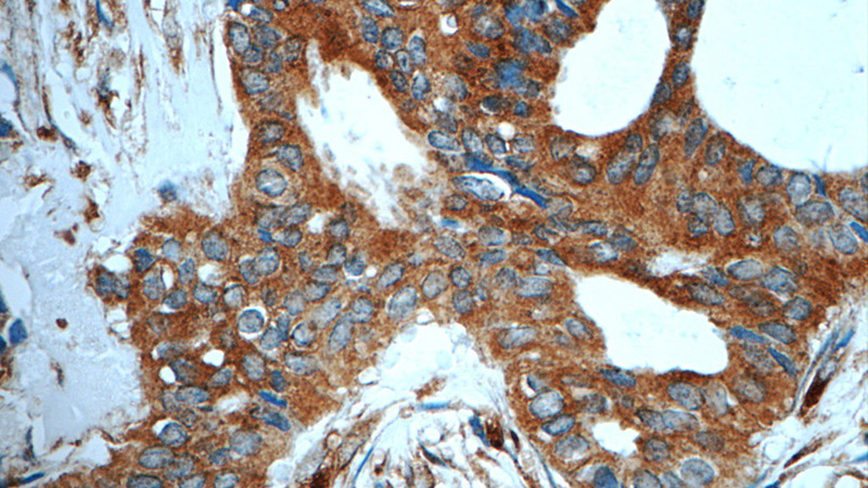 Immunohistochemistry of paraffin-embedded human breast cancer tissue slide using Catalog No:108252(ARFGAP3 Antibody) at dilution of 1:50 (under 40x lens)