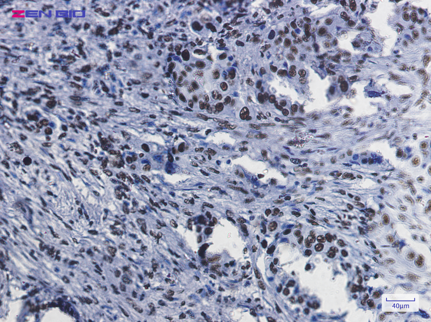 Immunohistochemistry of RbAp48 in paraffin-embedded Human lung cancer tissue using RbAp48 Rabbit pAb at dilution 1/20