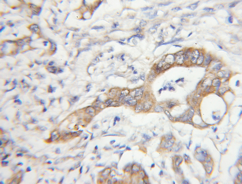 Immunohistochemical of paraffin-embedded human colon cancer using Catalog No:112765(MTAP antibody) at dilution of 1:50 (under 10x lens)