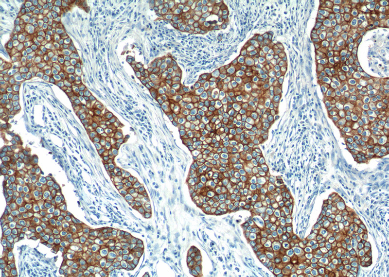 Immunohistochemistry of paraffin-embedded human breast cancer tissue slide using Catalog No:109800(KRT18 Antibody) at dilution of 1:1000 (under 10x lens).