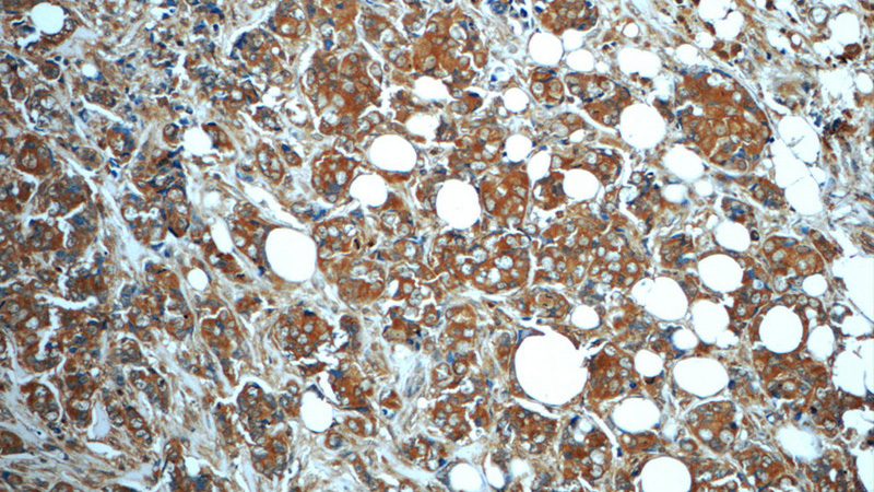 Immunohistochemistry of paraffin-embedded human breast cancer slide using Catalog No:112712(MN1 Antibody) at dilution of 1:50 (under 10x lens)