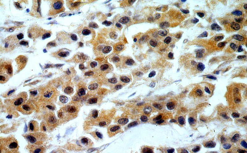 Immunohistochemical of paraffin-embedded human breast cancer using Catalog No:109217(CHD1 antibody) at dilution of 1:100 (under 40x lens)