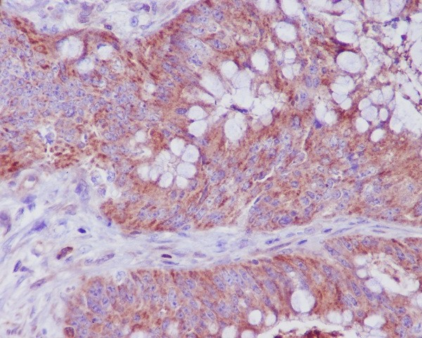 Immunohistochemical analysis of paraffin-embedded human adenocarcinoma of colon, using Bax Antibody.