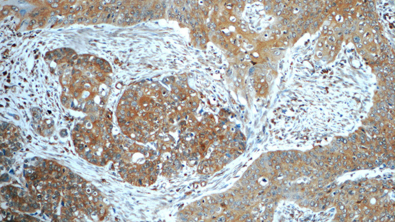 Immunohistochemistry of paraffin-embedded human cervical cancer tissue slide using Catalog No:111869(IFNG Antibody) at dilution of 1:50 (under 10x lens)