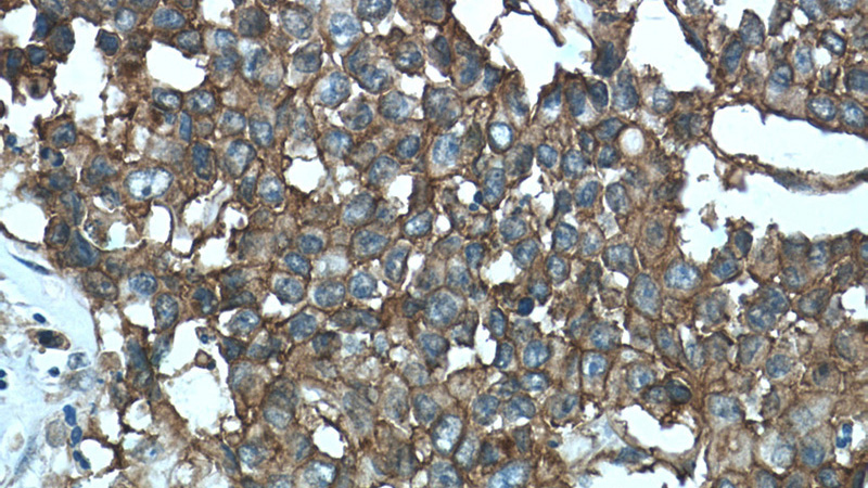 Immunohistochemistry of paraffin-embedded human colon cancer tissue slide using Catalog No:107144(CD9 Antibody) at dilution of 1:50 (under 40x lens)