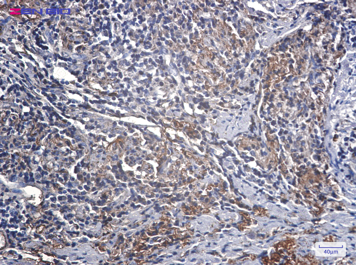 Immunohistochemistry of IGFBP7 in paraffin-embedded Human lung cancer tissue using IGFBP7 Rabbit pAb at dilution 1/20