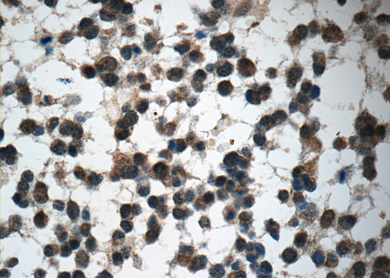 Immunohistochemistry of paraffin-embedded human gliomas tissue slide using Catalog No:110826(GAGE7 Antibody) at dilution of 1:50 (under 40x lens)