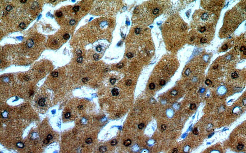 Immunohistochemical of paraffin-embedded human hepatocirrhosis using Catalog No:107777(ADAT2 antibody) at dilution of 1:50 (under 40x lens)