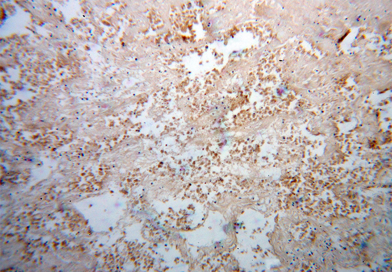 Immunohistochemical of paraffin-embedded human lung cancer using Catalog No:109999(DLX3 antibody) at dilution of 1:100 (under 10x lens)