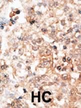 Formalin-fixed and paraffin-embedded human cancer tissue reacted with the primary antibody, which was peroxidase-conjugated to the secondary antibody, followed by DAB staining. This data demonstrates the use of this antibody for immunohistochemistry; clin