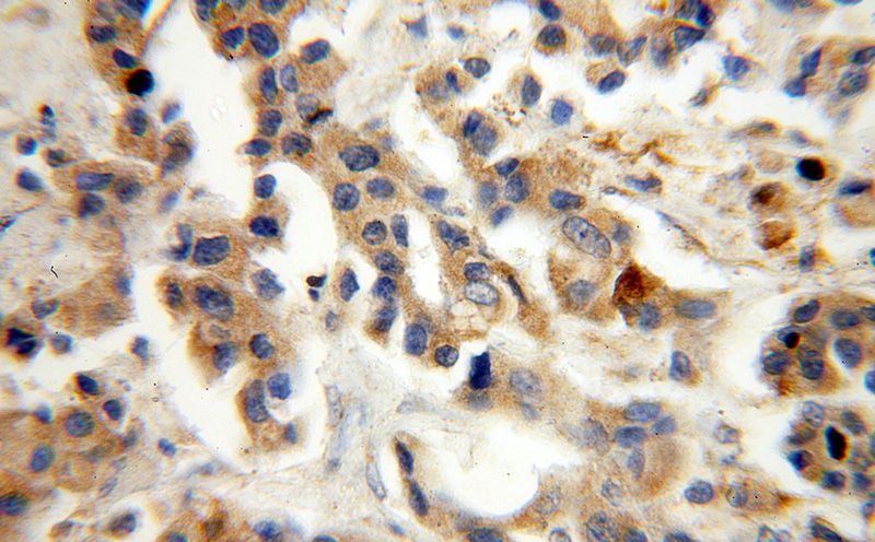 Immunohistochemical of paraffin-embedded human breast cancer using Catalog No:115630(ST6GALNAC5 antibody) at dilution of 1:100 (under 40x lens)