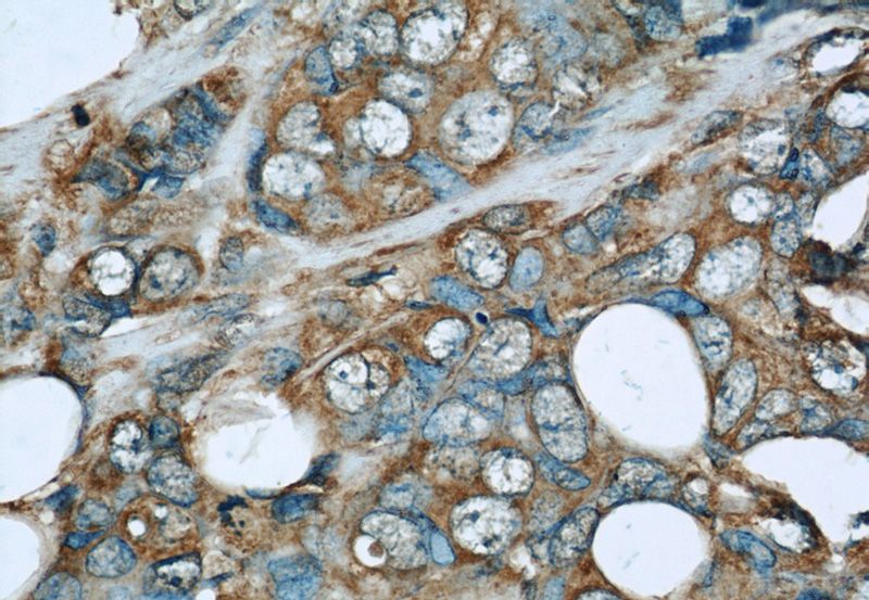 Immunohistochemistry of paraffin-embedded human breast cancer slide using Catalog No:107363(KNG1 Antibody) at dilution of 1:50