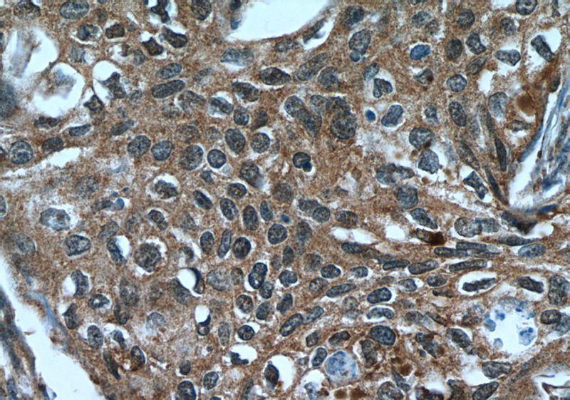 Immunohistochemistry of paraffin-embedded human cervical cancer tissue slide using Catalog No:108635(C10orf68 Antibody) at dilution of 1:50 (under 40x lens)