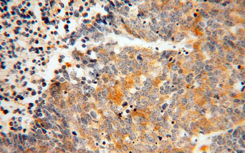 Immunohistochemical of paraffin-embedded human lung cancer using Catalog No:117125(ARRB1 antibody) at dilution of 1:100 (under 40x lens)