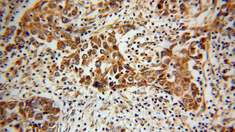 Immunohistochemical of paraffin-embedded human pancreas cancer using Catalog No:113301(NOMO2 antibody) at dilution of 1:100 (under 40x lens)