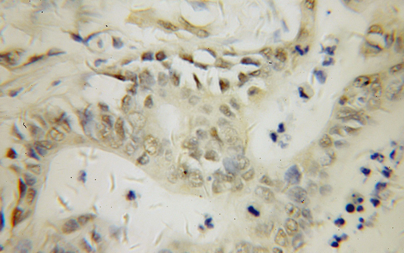 Immunohistochemical of paraffin-embedded human pancreas cancer using Catalog No:113594(PARP3 antibody) at dilution of 1:50 (under 40x lens)
