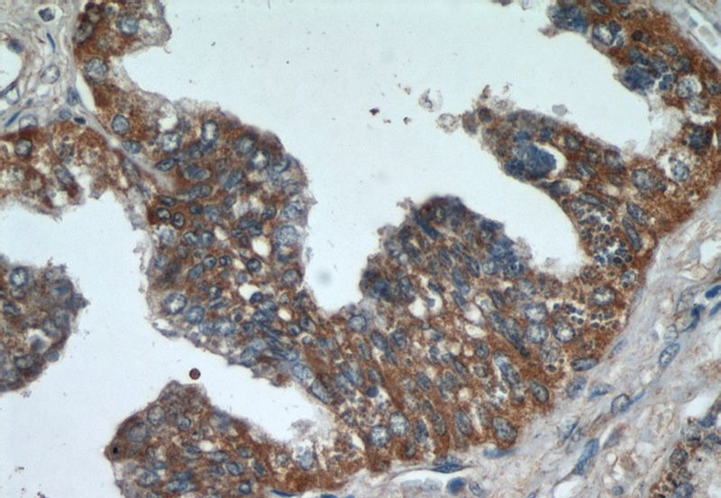 Immunohistochemical of paraffin-embedded human prostate hyperplasia using Catalog No:108721(C3orf21 antibody) at dilution of 1:50 (under 40x lens)