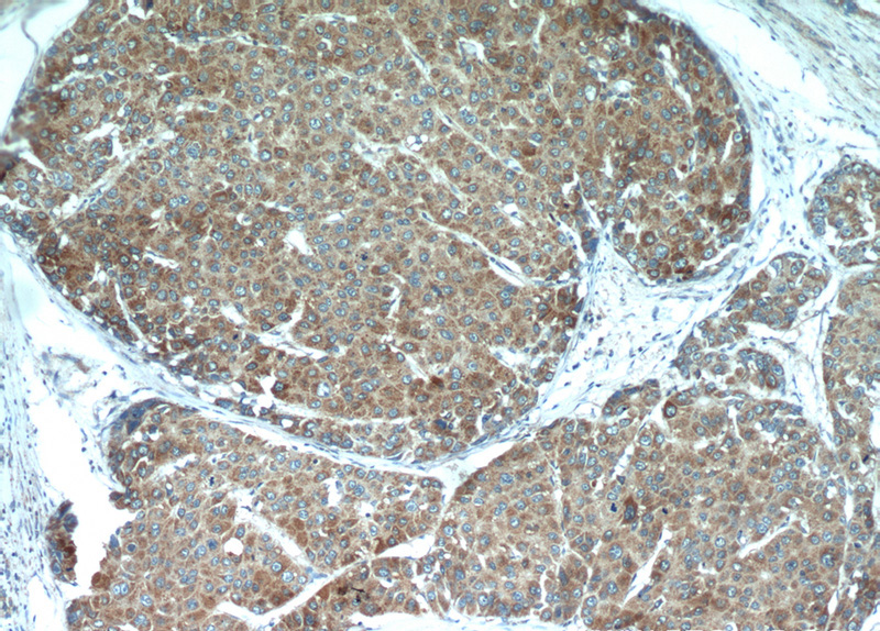 Immunohistochemical of paraffin-embedded human liver cancer using Catalog No:115996(TFAM antibody) at dilution of 1:50 (under 10x lens)