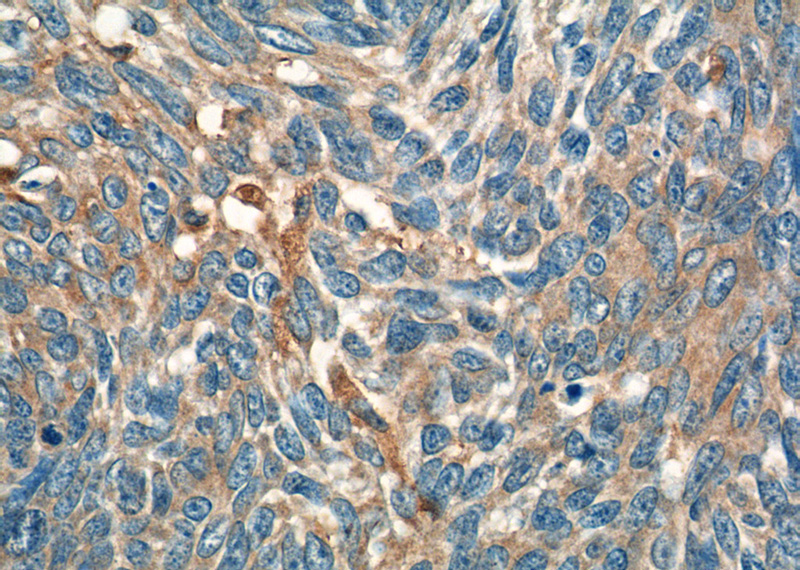 Immunohistochemistry of paraffin-embedded human skin cancer tissue slide using Catalog No:111768(IL19 Antibody) at dilution of 1:50 (under 40x lens)