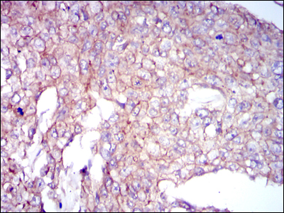 Immunohistochemical analysis of paraffin-embedded breast cancer tissues using COTL1 mouse mAb with DAB staining.