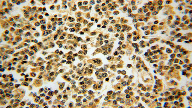 Immunohistochemical of paraffin-embedded human lymphoma using Catalog No:111492(HMOX2 antibody) at dilution of 1:100 (under 40x lens)
