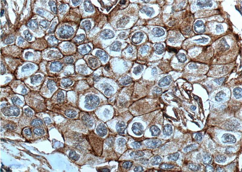 Immunohistochemistry of paraffin-embedded human breast cancer tissue slide using Catalog No:107188(CXCR7 Antibody) at dilution of 1:200 (under 40x lens). heat mediated antigen retrieved with Tris-EDTA buffer(pH9).