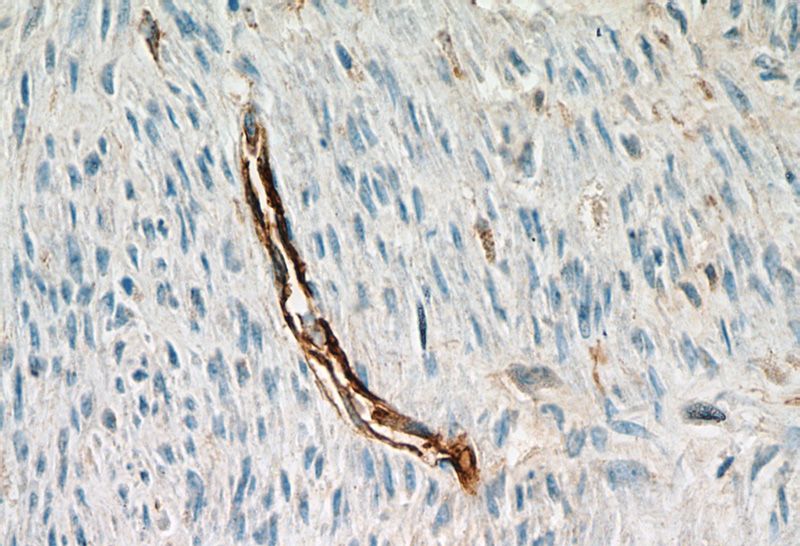 Immunohistochemical of paraffin-embedded human hysteromyoma using Catalog No:109030(CD34 antibody) at dilution of 1:50 (under 40x lens)